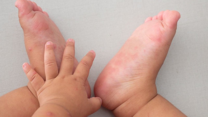 Dự kiến tháng 7 sẽ có thuốc điều trị bệnh tay chân miệng về Việt Nam
